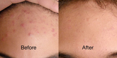Blue Light Acne Treatment Before and After