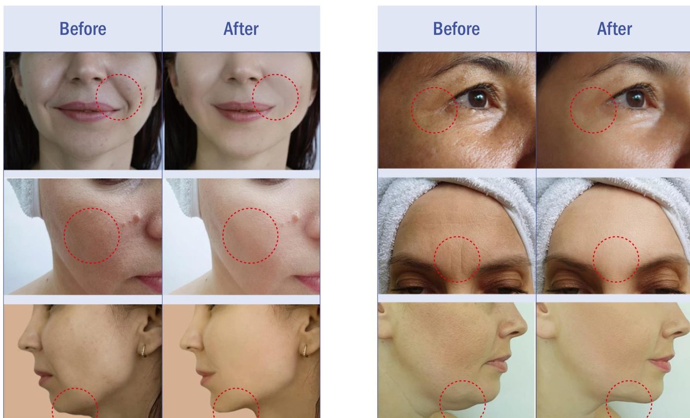 LXC before and after results