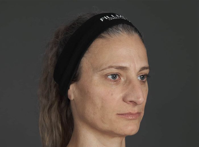 Patient after combined ART FILLER and NCTF treatment