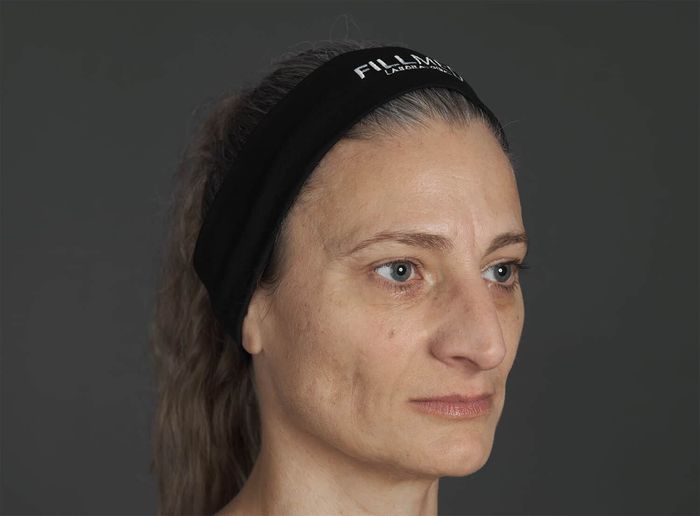 Patient before combined ART FILLER and NCTF treatment