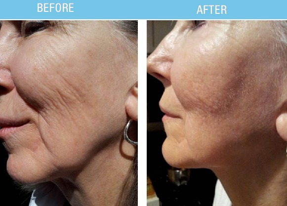 Client-supplied before-and-after photographs of the cheek area, taken from different angles