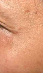 Eye-area skin after NCTF treatment