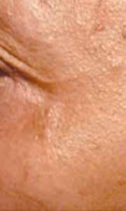 Eye-area skin before NCTF treatment